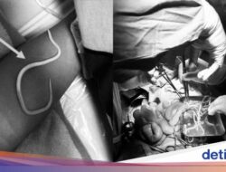 Ngilu, Praktisi Medis Ke Jember Keluarkan Cacing Hidup Ke Perut Bocah 3 Tahun