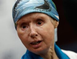 Curhat Wanita Wajahnya Rusak usai Diserang Simpanse, Sempat Mengira Tak Selamat