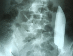 Momen Menegangkan Ahli Kebugaran ‘Cabut’ Pisau Berukuran 15 Cm Bersama Perut Pria Ini