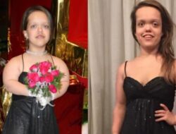 Transformasi Wanita AS usai Operasi Peninggi Badan, Bersama 117 Cm Karena Itu 151 Cm