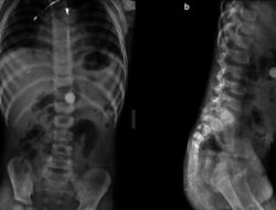 Foto-foto Rontgen Temuan Benda Aneh Untuk Tubuh, Alat hingga Kawat Besi