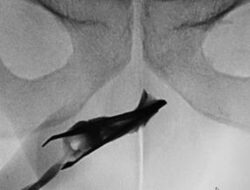 Ngilu! Momen Praktisi Medis Temukan Pinset ‘Nyangkut’ Di Mr P Pada 4 Tahun