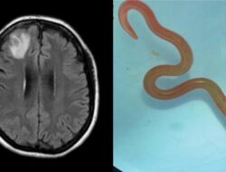 Ngeri, Praktisi Medis Temukan Cacing Parasit Ular Piton 8 Cm Hingga Otak Wanita Australia